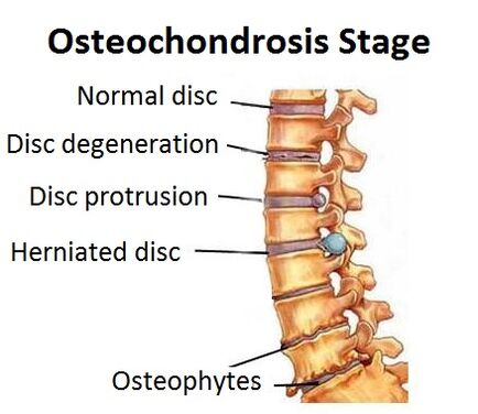 Phase d'ostéochondrose